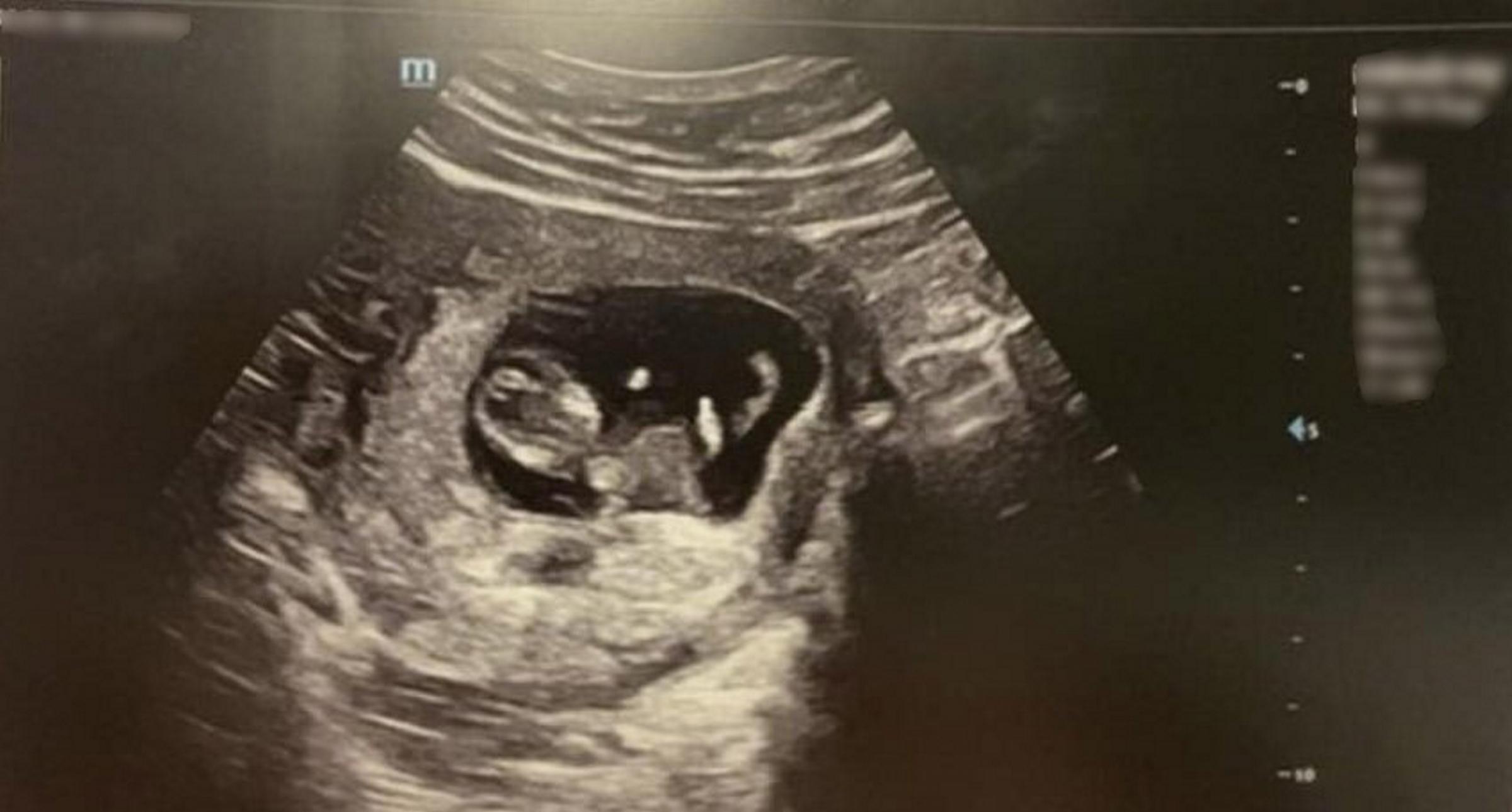 Maddy Lundstrams, 20, baby girl stuck two fingers up at her during a private 25 week scan.